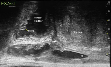 Visualization of Old and New Biopsy Needle Track.