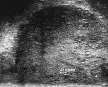 Visualization of Old and New Biopsy Needle Track.